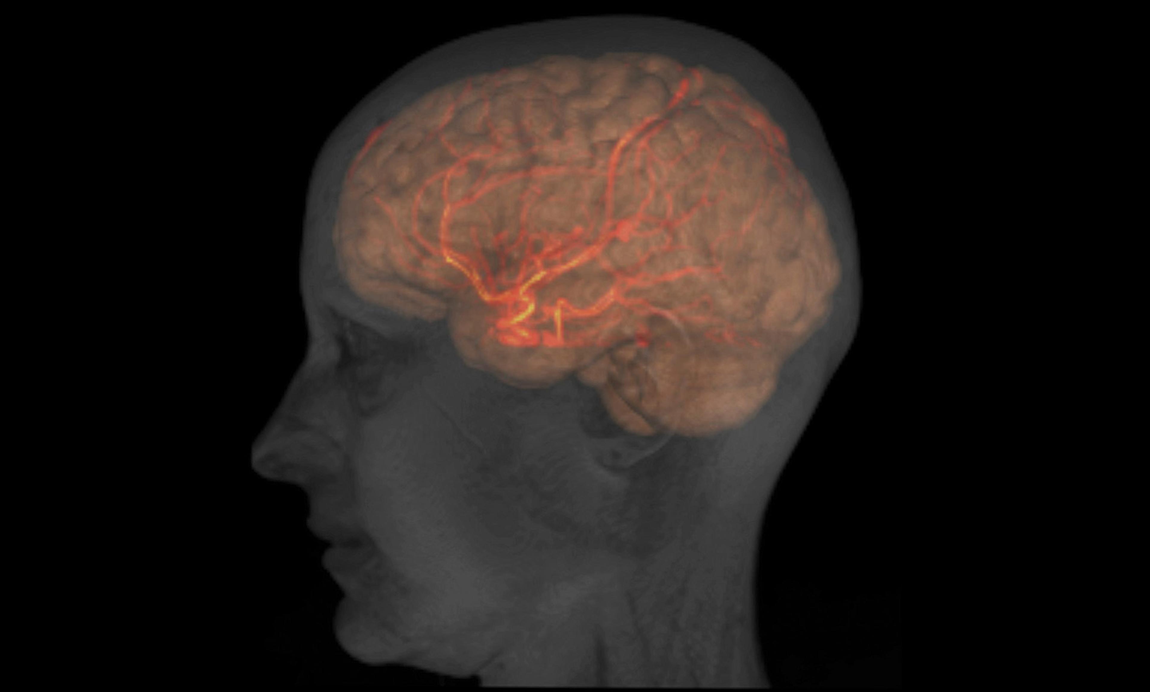 Digital image showing a semi-transparent side profile of a human head with a detailed view of the brain and arteries in orange.